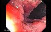 Multiple Adenomatous Polyps Of The Rectum (17 of 37)