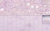 Blood - Chronic Lymphocytic Leukemia