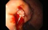 Gastric Varices - Endoscopic Ablation With Cyanoacrylate Glue (10 of 18)