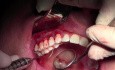 Graft Suturing - Gingival Grafting #3-6 Sites