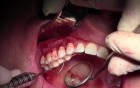 Graft Suturing - Gingival Grafting #3-6 Sites
