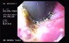 Hemorrhage due status post rubber band ligation of esophageal varices (5 of 25)