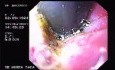 Hemorrhage due status post rubber band ligation of esophageal varices (5 of 25)