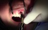 Atraumatic Extraction, II - Extraction #9 with GBR-Socket Grafting