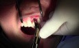 Atraumatic Extraction, II - Extraction #9 with GBR-Socket Grafting