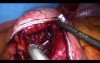 Laparoscopic Gastric Bypass - Part 4
