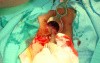 Fistula in Ano (7 of 7)