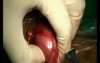 Colloid Nodules Of Thyroid