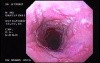 Barrett´s Esophagus -hyperplastic polyp -(3 of 4)