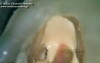 Maxillary Molar Obturation Stories Under Magnification