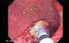 Multiple Adenomatous Polyps Of The Rectum (9 of 37)