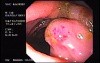 Zollinger- Ellison Syndrome - Gastric Ulcer with Gastrocolic Fistula (4 of 21)