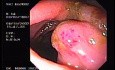 Zollinger- Ellison Syndrome - Gastric Ulcer with Gastrocolic Fistula (4 of 21)