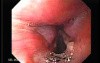 Laryngopharyngeal reflux (LPR) (1 of 2) - Granuloma