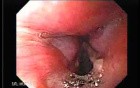 Laryngopharyngeal reflux (LPR) (1 of 2) - Granuloma
