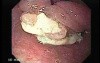 Esophageal Squamous Cell Carcinoma of the the upper third of the Esophagus that invades the subglotic (2 of 8)