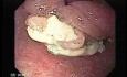 Esophageal Squamous Cell Carcinoma of the the upper third of the Esophagus that invades the subglotic (2 of 8)
