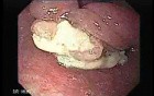 Esophageal Squamous Cell Carcinoma of the the upper third of the Esophagus that invades the subglotic (2 of 8)