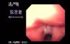 Carcinoma of the larynx - genereal view