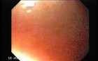 Gastrointestinal Stromal Tumor - GIST (4 of 13)