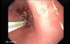 Adenocarcinoma of the middle third (3 of 5 )