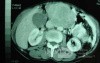 Gastric Ulcer with Gastrocolic fistula due to a Zollinger-
 Ellison Syndrome (31 of 33)