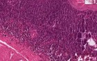 Branchial cyst (lymphoepithelial cyst) - Histopathology of neck