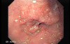 Adenocarcinoma of the Middle Third of Esophagus - 47 Years-Old Woman with Dysphagia