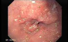 Adenocarcinoma of the Middle Third of Esophagus - 47 Years-Old Woman with Dysphagia