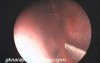Submucosal Resection Of Septum