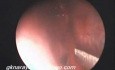 Submucosal Resection Of Septum