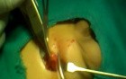 Congenital Hydrocele