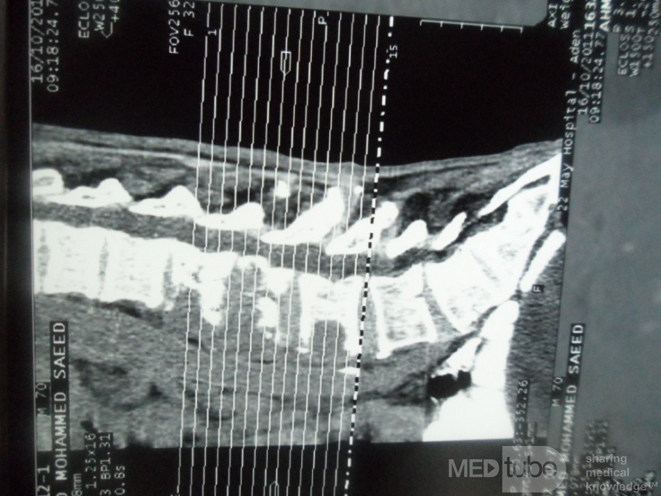 Pancreas cancer - 12