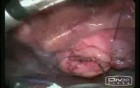 Laparoscopy For Repair Of Rupture Of Urinary Bladder