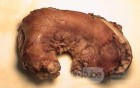 Plastic Linitis with bilateral Krukenberg´s tumor (8 of 13)