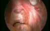 Laparoscopic Myomectomy