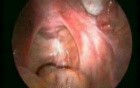 Laparoscopic Myomectomy