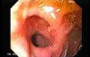 Choledocoduodenostomy and The Sump Syndrome (2 of 10)
