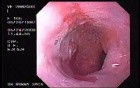 Barret´s Esophagus long segment (1 of 4)