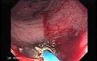 Endoscopic Resection of Giant Tubulo-Villous of the rectum (33 of 35)