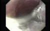 Achalasia - Presence of Residual Saliva