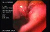 Intraluminal Endoscopic Suturing - Assessment of the First Gastroplicature, Part 1