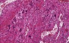 Multiple sclerosis