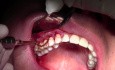 Gingival Grafting #3-6 Sites