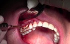 Gingival Grafting #3-6 Sites