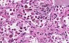 Organizing pneumonia - Histopathology - Lung