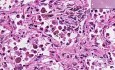 Organizing pneumonia - Histopathology - Lung