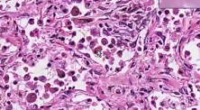Organizing pneumonia - Histopathology - Lung