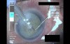 Cataract Surgery I - 2
