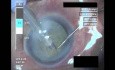 Cataract Surgery I - 2